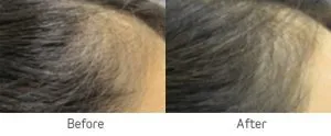 Viviscal Professional Before and After